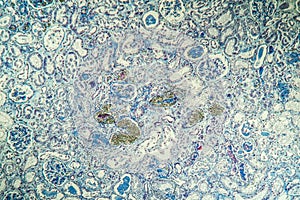 Fibrin deposits in the kidney, microscopy photo