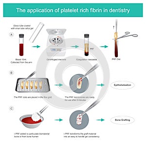 Fibrin-rich platelets PRF in dentistry. Development of biologically active surgical additives to control inflammation and speed