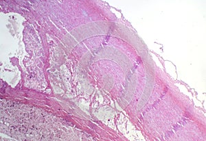 Fibrinoid necrosis in a vessel wall, light micrograph