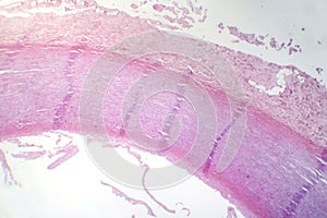 Fibrinoid necrosis in a vessel wall, light micrograph