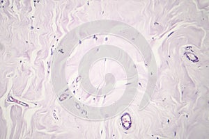 Fibroadenoma, light micrograph photo