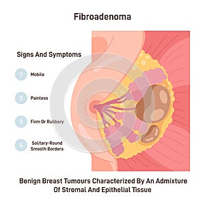 Fibroadenoma. Neoplasm in female chest. Benign breast tumour