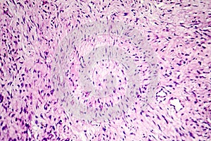 Fibroma, a benign tumour of fibrous tissue