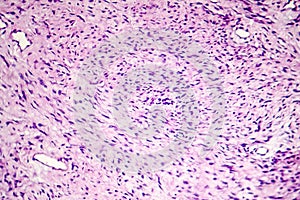 Fibroma, a benign tumour of fibrous tissue