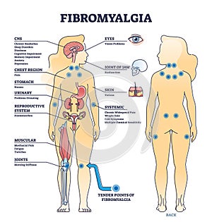 Fibromyalgia as musculoskeletal pain disorder tender points outline diagram