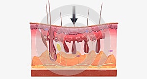 With fibromyalgia, nerves become hypersensitive to external stimuli, a change known as central sensitization