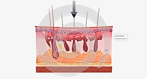 With fibromyalgia, nerves become hypersensitive to external stimuli, a change known as central sensitization photo