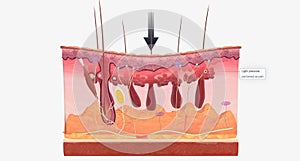 With fibromyalgia, nerves become hypersensitive to external stimuli, a change known as central sensitization photo