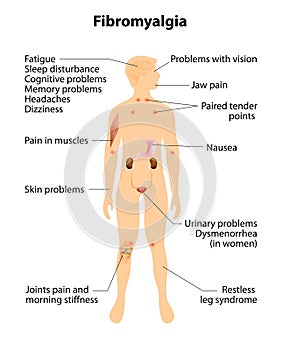 Fibromyalgia. signs and symptoms.