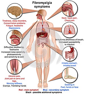 Fibromyalgia symptoms medical vector illustration isolated on white background infographic