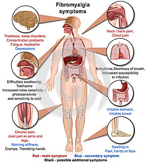 Fibromyalgia symptoms medical vector illustration isolated on white background infographic photo