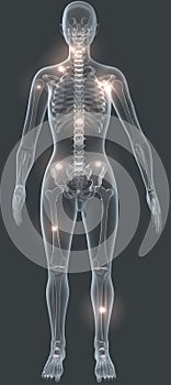 Fibromyalgia syndrome