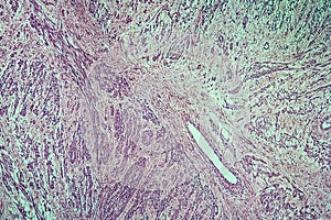 Fibromyoma of the uterus diseased tissue