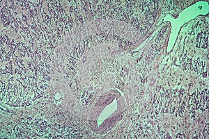 Fibromyoma of the uterus diseased tissue