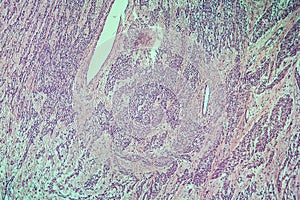 Fibromyoma of the uterus diseased tissue