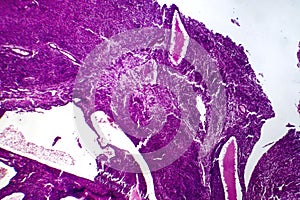 Fibrosarcoma, light micrograph