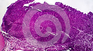 Fibrosarcoma, light micrograph photo