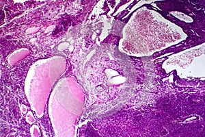 Fibrosarcoma, light micrograph photo