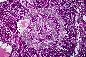 Fibrosarcoma, light micrograph photo