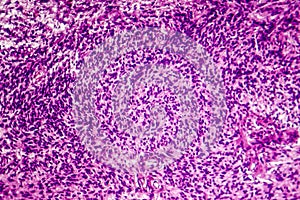 Fibrosarcoma, malignant tumor of fibroblasts