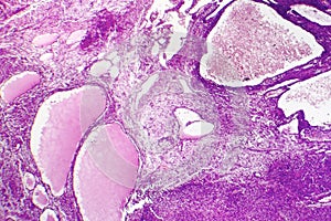 Fibrosarcoma, malignant tumor of fibroblasts photo