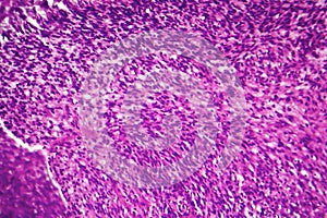 Fibrosarcoma, malignant tumor of fibroblasts photo