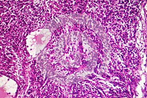 Fibrosarcoma, malignant tumor of fibroblasts photo