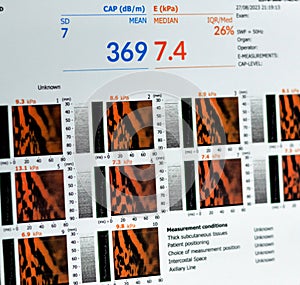 Fibroscan examination study of the liver revealed F2 for liver stiffness, S3 for liver steatosis, fibrosis reading 7.4 kPa, CAP