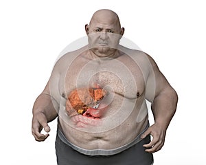 Fibrotic liver in obese man, 3D illustration. Concept of obesity and inner organs diseases