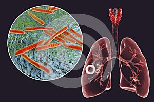 Fibrous-cavernous pulmonary tuberculosis