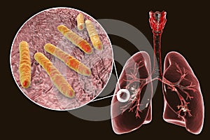 Fibrous-cavernous pulmonary tuberculosis photo