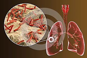 Fibrous-cavernous pulmonary tuberculosis photo