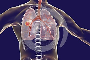 Fibrous-cavernous pulmonary tuberculosis photo