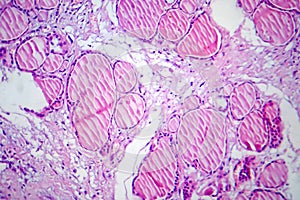 Fibrous thyroiditis, light micrograph