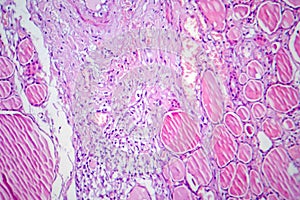 Fibrous thyroiditis, light micrograph