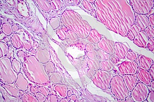 Fibrous thyroiditis, light micrograph