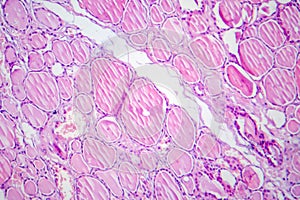 Fibrous thyroiditis, light micrograph photo