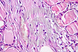 Fibrous thyroiditis, light micrograph photo