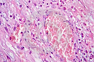 Fibrous thyroiditis, light micrograph photo