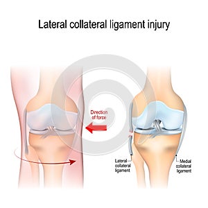 Fibular collateral ligament injury. joint anatomy