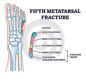 Fifth metatarsal or foot little finger fracture after injury outline diagram