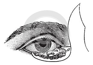 Fig. 177. Blepharoplasty by the method of Blasius, vintage engraving