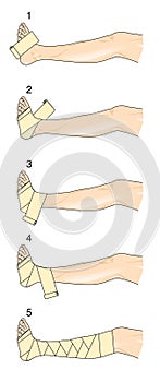 Figure of eight leg bandage