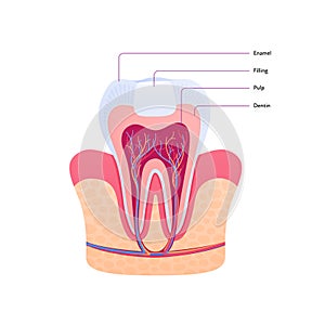 Filled tooth chart. Vector biomedical illustration. Cross section. Teeth with filling in gum isolated on white background. Design