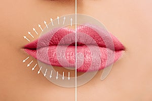 Fillers. Lip augmentation. Beautiful pink lips photo