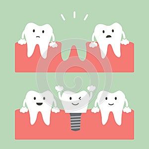 Filling dental implant with crown, before and after