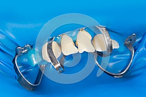 Filling of human teeth, close-up. Treatment with polymer fillings at the dentistÃ¢â¬â¢s appointment photo