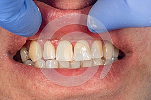 Filling of human teeth, close-up. Treatment with polymer fillings at the dentistÃ¢â¬â¢s appointment photo