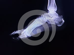 Film  Ankle joint Clost up fracture right Calcaneus.Soft tissu swelling Medical image concept.