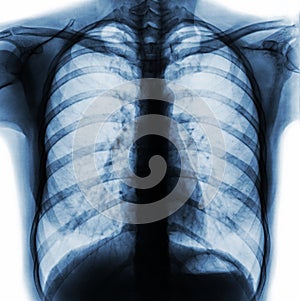 Film chest x-ray PA upright show normal human chest